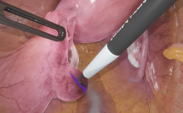 GynoS™ procedure view